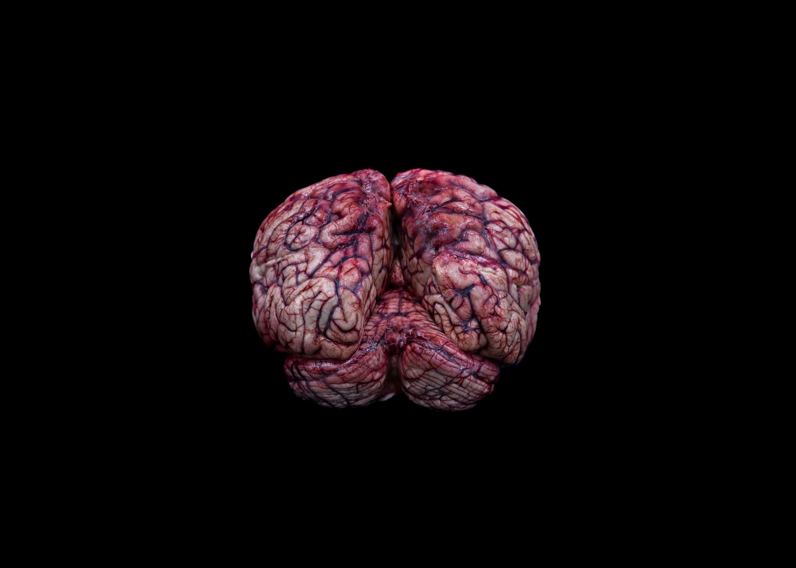 Human Brain - Man 46